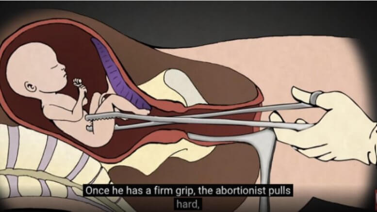 15 weeks gestation