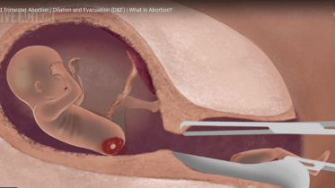 D and E Abortion